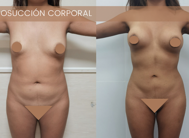 Descubre la transformación con la liposucción: Resalta tu belleza natural